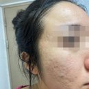 12 | 대구 새살침 - 내돈내산 12회 치료 찐막 후기