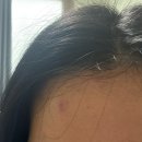 더리턴피부과의원 | 논산 피부과 [더올린의원 클리닉] 후기/ 여드름 염증 주사