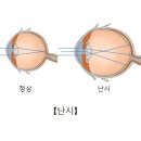 난시(Astigmatism) 눈 질환이란? 이미지