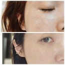 미작뷰티 수지상현점 눈밑 잡티제거 후기