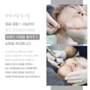 공한의원 | 쌍수 붓기 기간 후 짝눈 걱정은 한의원에서 깔끔하게 덜기