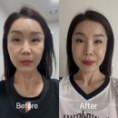 홍프로짐 | 강남역피부과 50대후반 텐써마 300샷 고주파리프팅 후기