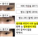 티에스 성형외과 쌍커풀 라인 낮추기 (소세지눈) 당일 후기