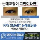 안양성형외과 눈매교정후기 ♥
