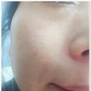때 | 비판텐크림 피부 뒤집어졌을 때 후기