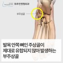 부주상골증후군 군대 앞두고 걱정이라면 안전하고 빠른 치료의 여기 이미지