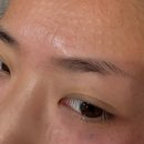 디에이치페이스업의원 | 이마, 볼 리쥬란 3cc 후기 (가격도 통증도 너무 아팠)