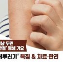 피부 곰팡이균 원인 피부 어루러기 증상 예방 치료 종류 이미지