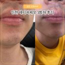 인천 레이저제모 송도 성형외과에서 한 후기