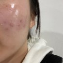 은평구피부관리 울트라플라즈마로 모공완화했던 라운뷰티 후기