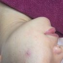 라인메디 | 청학동피부관리 동춘동피부관리 메디결라인에서 민감성 트러블 관리중인 후기