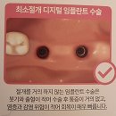 임플란트의모든것