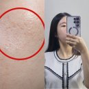 상계동 피부과 한의원 여드름패인흉터 제거방법 새살침 치료 후기