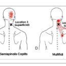 Semispinalis Capitis (두반극근) 이미지