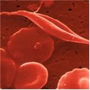 운동선수들의 겸상적혈구(Sickle cell)질환 이미지