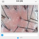 한올두피탈모