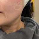 이수역(7) | 이수역 피부과 티타늄리프팅 후기