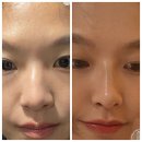 나실약국 | 부천하이코 잘하는 피부과에서 코 컴플렉스 극복한 찐 후기