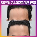 [20대 남자 모발이식 후기 M자 헤어라인 교정] 비절개 히든컷 3400모 1년 전후 (모엠의원/M자탈모/전지훈원장) 이미지