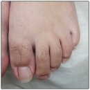 척척병원 | 문제성 발톱·무좀, 인천논현역 주손척척의원에서 치료한 솔직 후기