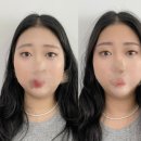 민락2지구 망한 눈썹문신 제거 레이저만이 답일까
