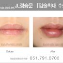 서면성형외과 JL정승문 입술확대수술 후기사진