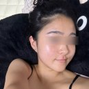 압구정피부과 텐써마 솔직 후기 !20대 탄력 리프팅 유지 기간 붓기