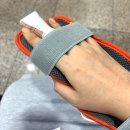 부산 임산부 손가락 골절 핀제거 수술 국소마취 선택
