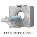 복부대동맥류(Abdominal aortic Aneurysm) 이미지