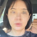 홍성희여성외과의원 | 우아성형외과 무마취 써마지600샷 내돈내산 통증 고통 화상 세기 네모 붓기 식빵 솔직후기