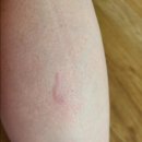 탄현수내과의원 | 🐶개한테 물렸어요ㅜㅜ 파상풍예방접종후기..비용😭