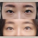 도곡유스앤영의원 | 도곡유스앤영 눈밑지방재배치 유지기간은 얼마나 될까?
