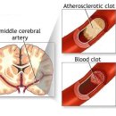 뇌졸중 전조 증상 과 예방 법 이미지