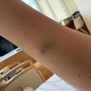 봄빛한의원 | [출산이야기]봄빛병원 제왕절개 후기 2일차(소변줄 제거, 넘어짐)