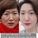 인셀덤신나라 | 내돈내산 인셀덤 쓰기 전 후 비교!