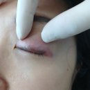 라인2차 | 미작뷰티강동점 아이라인 문신제거 2차 후기