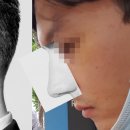 사진 들고 가서 필러 맞은 미스코 후기 (사진, 동영상 有)
