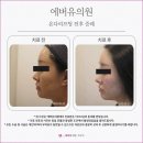 에버유의원 | 공덕피부과 온다리프팅? 원리, 장점, 추천 대상 모두 정리했습니다.