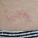 장땡반점 | [대상포진 후기] 대상포진 초기 증상, 흉터 안 지게 하는 법