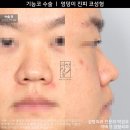 Dr.원흉부외과의원 | 기능코 비염 수술 후기 ㅣ 남자코 엉덩이 진피 수술 【Dr. 아베크 코성형】