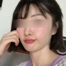 청담봄온클리닉 티타늄리프팅 플러스 80KJ 후기 효과대박