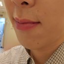 플러스 | 홍대피부과 남성레이저제모 젠틀맥스프로플러스 후기