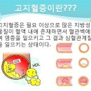 혈관 건강의 적신호, 고지혈증 이미지