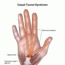 carpal tunnel syndrome ( 手根管症候群 ) 이미지