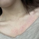 메이성형외과의원 | 영통역 가성비 편평사마귀 제거 “메이퓨어 수원영통점”