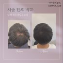리아앤스칼프 | 대구두피문신 잘하는 곳, 리아앤스칼프, 모발이식 언제?