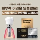 보성치과기공소 | 광주임플란트치과 앞니염증치아도 디지털임플란트로 3개월완성