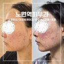 노원 강북예치과병원 | 노원역피부과 스컬피오 리프팅레이저 안아픈리프팅 받고 온 후기와 효과