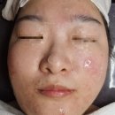 시흥동피부관리 SH뷰티라운지 여드름관리 받고 피부 진정시키기