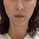 검단 아라역피부과 고현정리프팅 텐써마 300샷 효과 후기